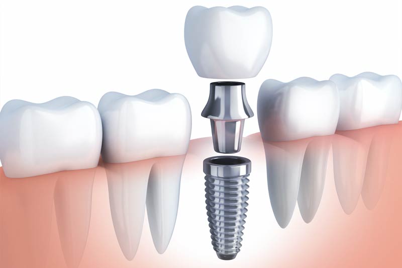 Implants Dentist in New York