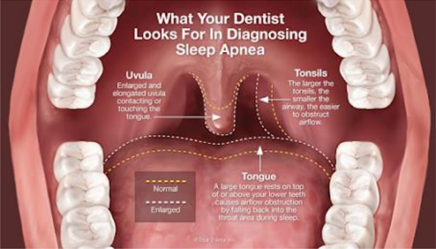 Sleep Apnea Treatment in New York