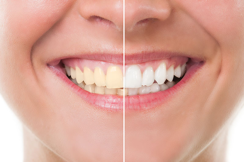 Teeth Whitening in New York